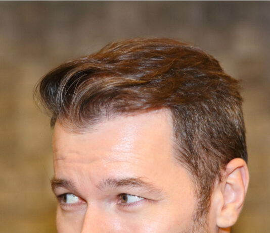 Haarverpflanzung in der Türkei: Gründe, Vorteile und Tipps Eine Haarverpflanzung in der Türkei hat viele Vorteile @www.haartransplantation-tuerkei.com