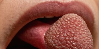 HIV: Wie die Zunge Hinweise auf eine Infektion geben kann HIV: Wie die Zunge Hinweise auf eine Infektion geben kann